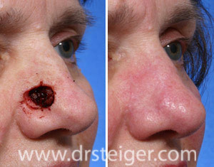 paramedian forehead flap before and after