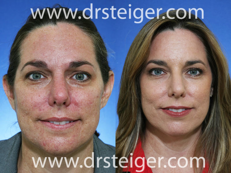 CO2 LASER TREATMENT BEFORE & AFTER PHOTOS