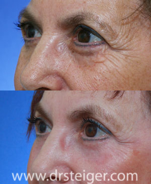 fractional-CO2-before-after