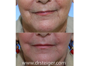 laser mouth wrinkles