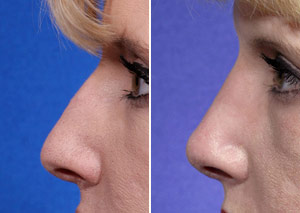 rhinoplasty for a hump