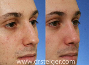 Rhinoplasty for a nose hump