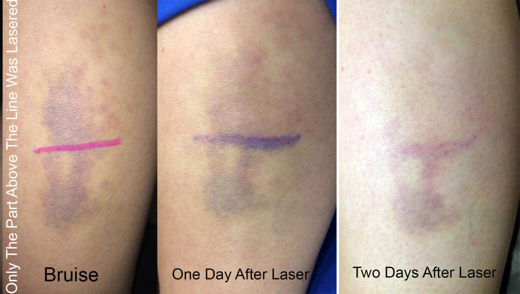 laser for bruises