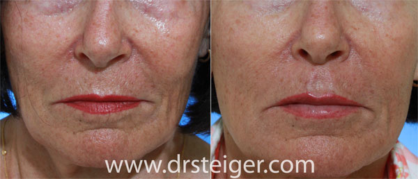 lip-augmentation-picture