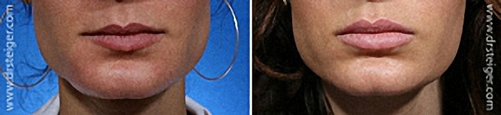 Lip Augmentation