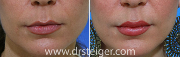 lip-enhancement-before-and-after