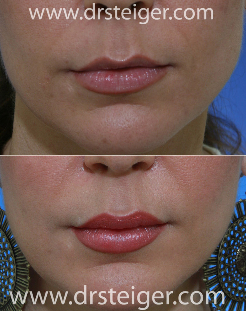 lip-enhancement-photos