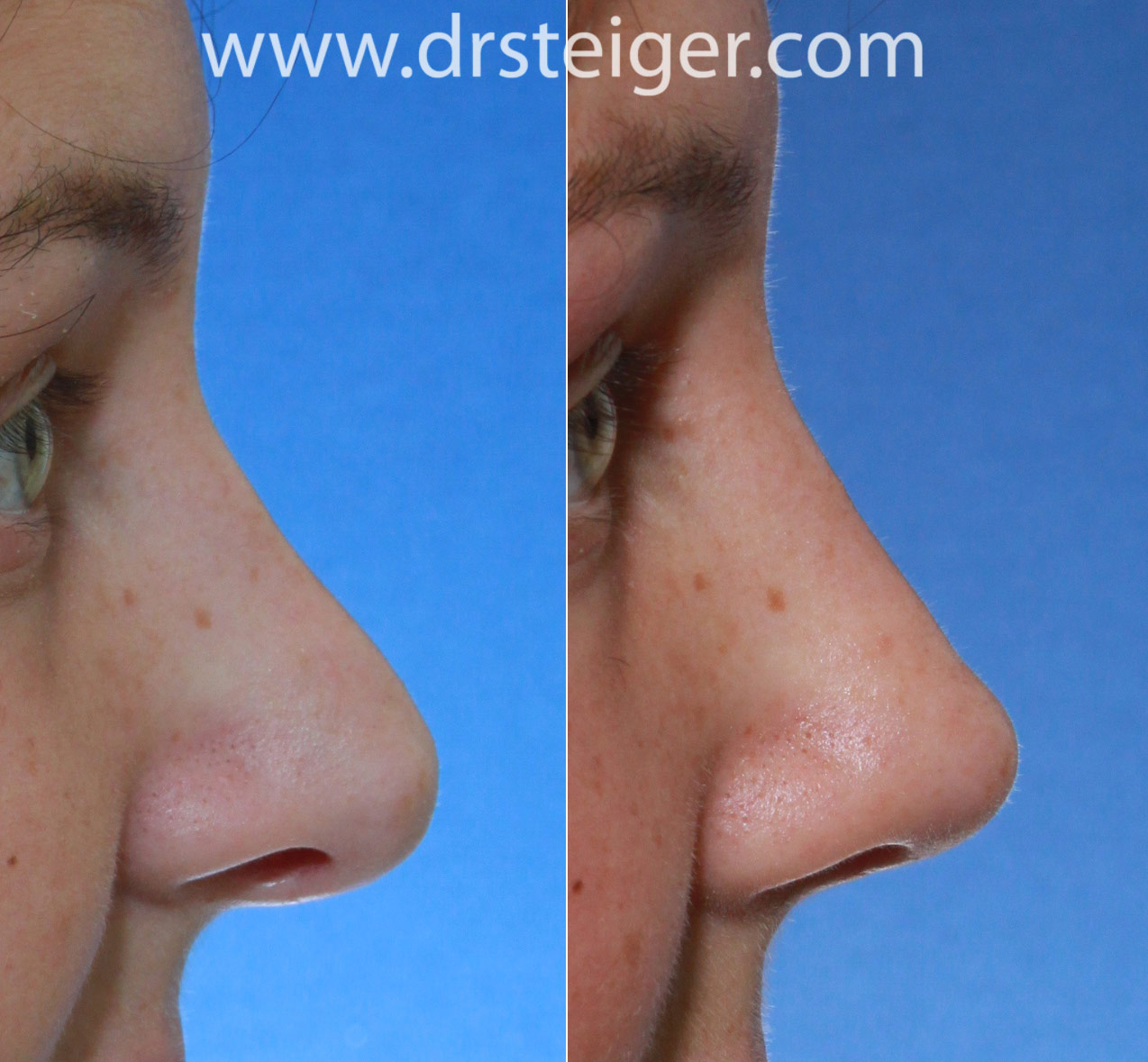 revision rhinoplasty to lift the nasal tip