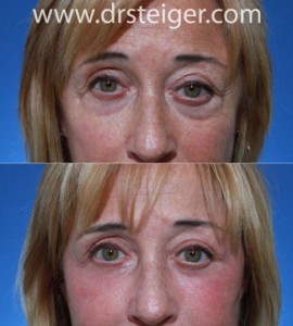 lower-blepharoplasty--fat-grafting