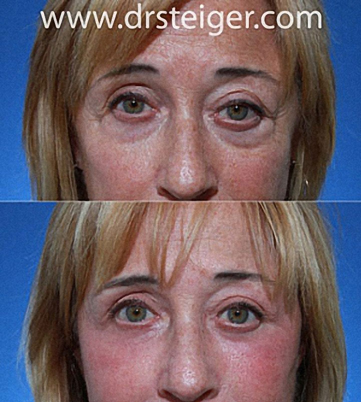 lower blepharoplasty with fat grafting