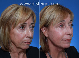 lower-blepharoplasty-rejuvenation