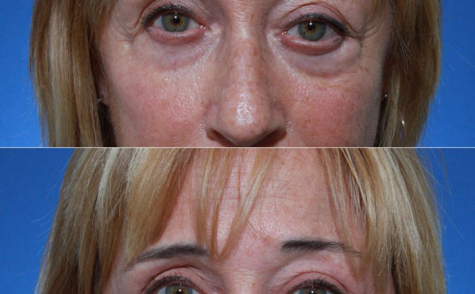 Lower Eyelid Blepharoplasty with Fat Grafting