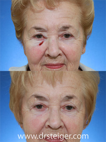 lower-eyelid-repair