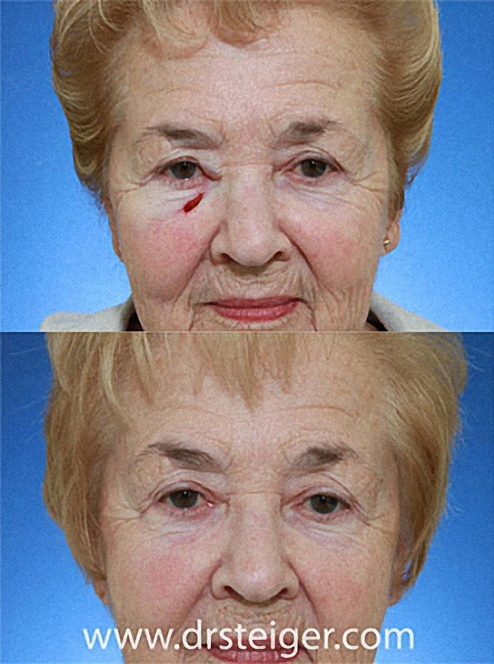 Lower Eyelid Repair