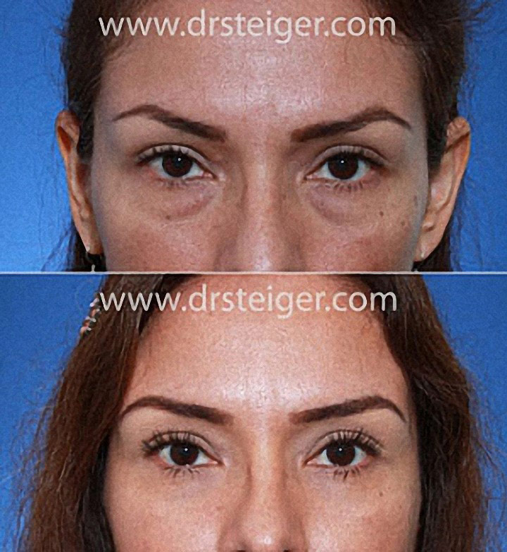 Lower Eyelid Bags Removal Surgery Steiger Facial Plastic Surgery