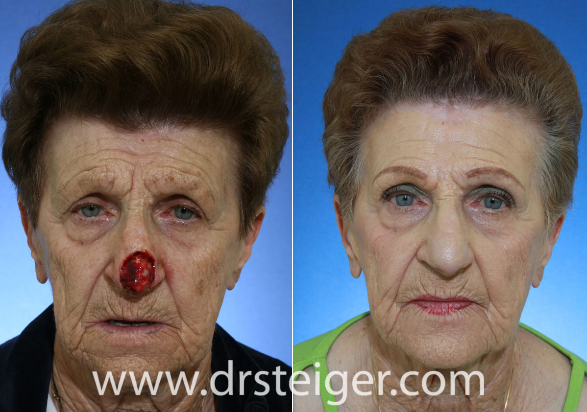 MOHS Surgery Reconstruction Before and After Photos