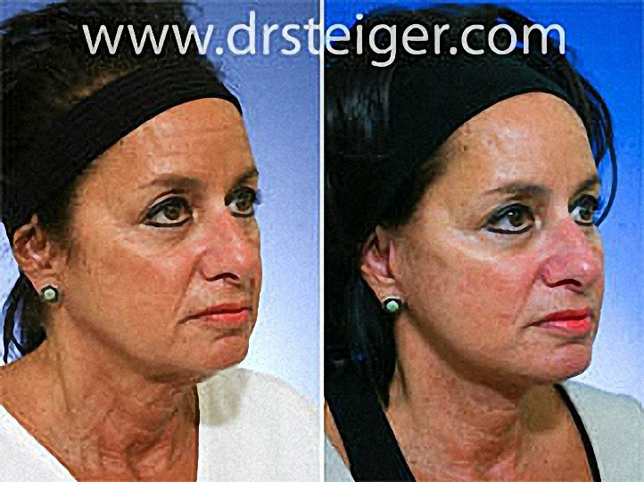 Neck Lift Plastic Surgery