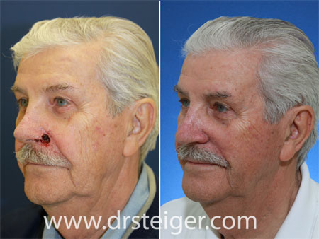 MOHS Surgery Reconstruction Before and After Photos