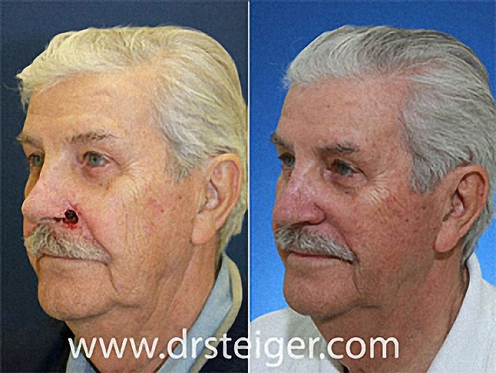 Nostril Reconstruction After MOHS Surgery