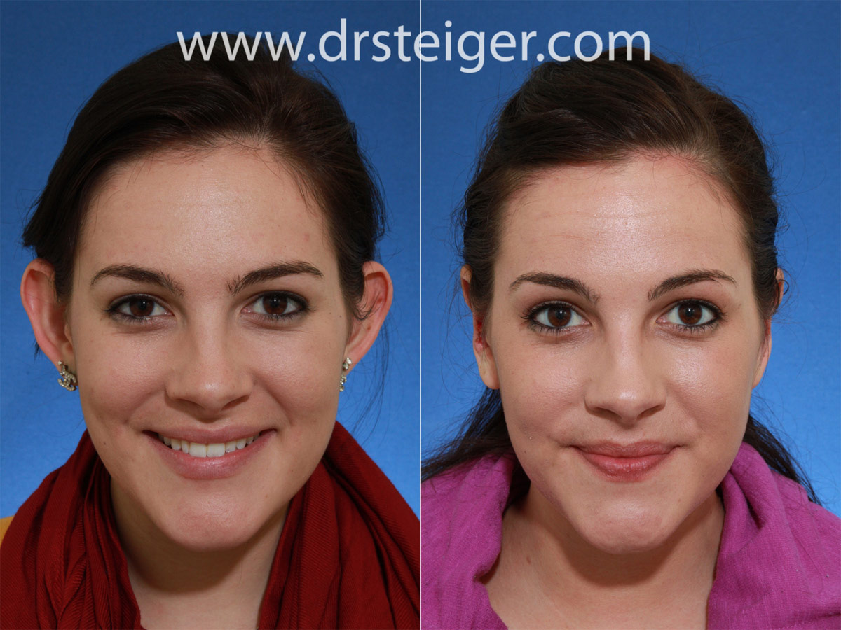 otoplasty before after