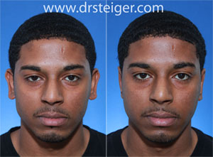 otoplasty in a black man