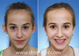 otoplasty photos