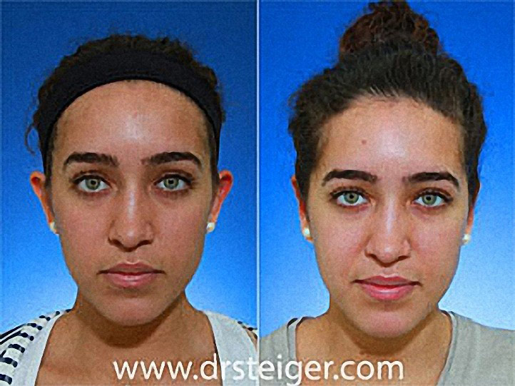 Otoplasty Photos