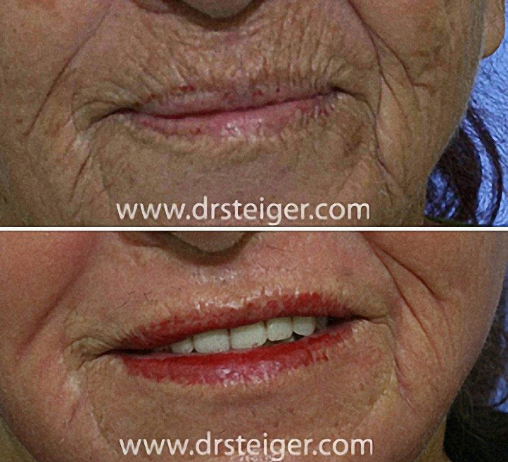 Perioral Dermabrasion Steiger Facial Plastic Surgery Boca Raton