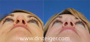 revision-rhinoplasty-alar-collapse