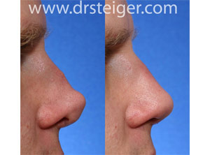 revision rhinoplasty after a bad nose job