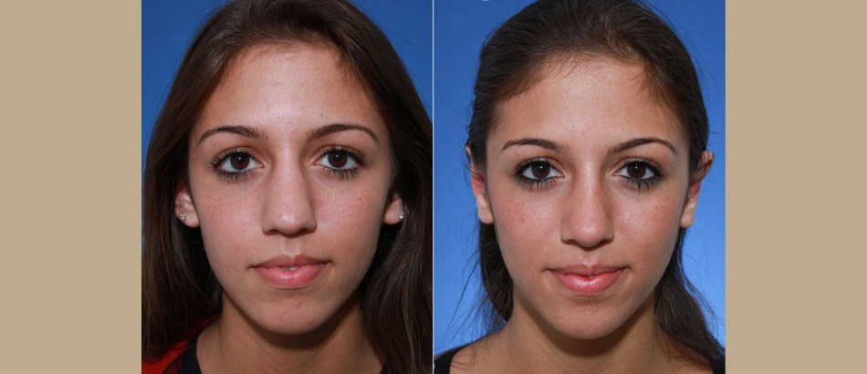 south florida rhinoplasty