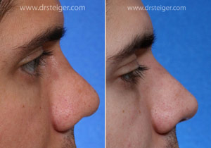 rhinoplasty after trauma to the nose