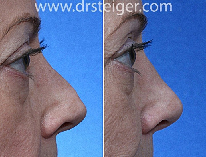rhinoplasty can make you look younger