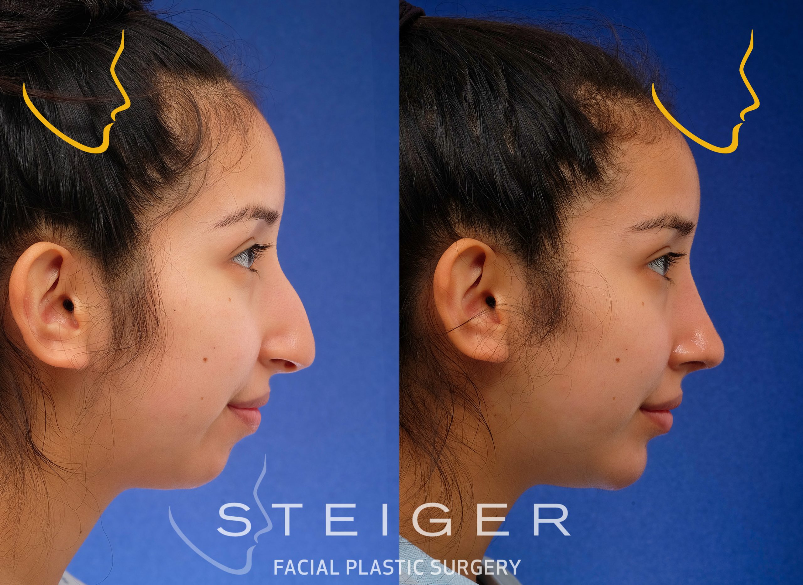 Rhinoplasty and chin implant for a droopy nose