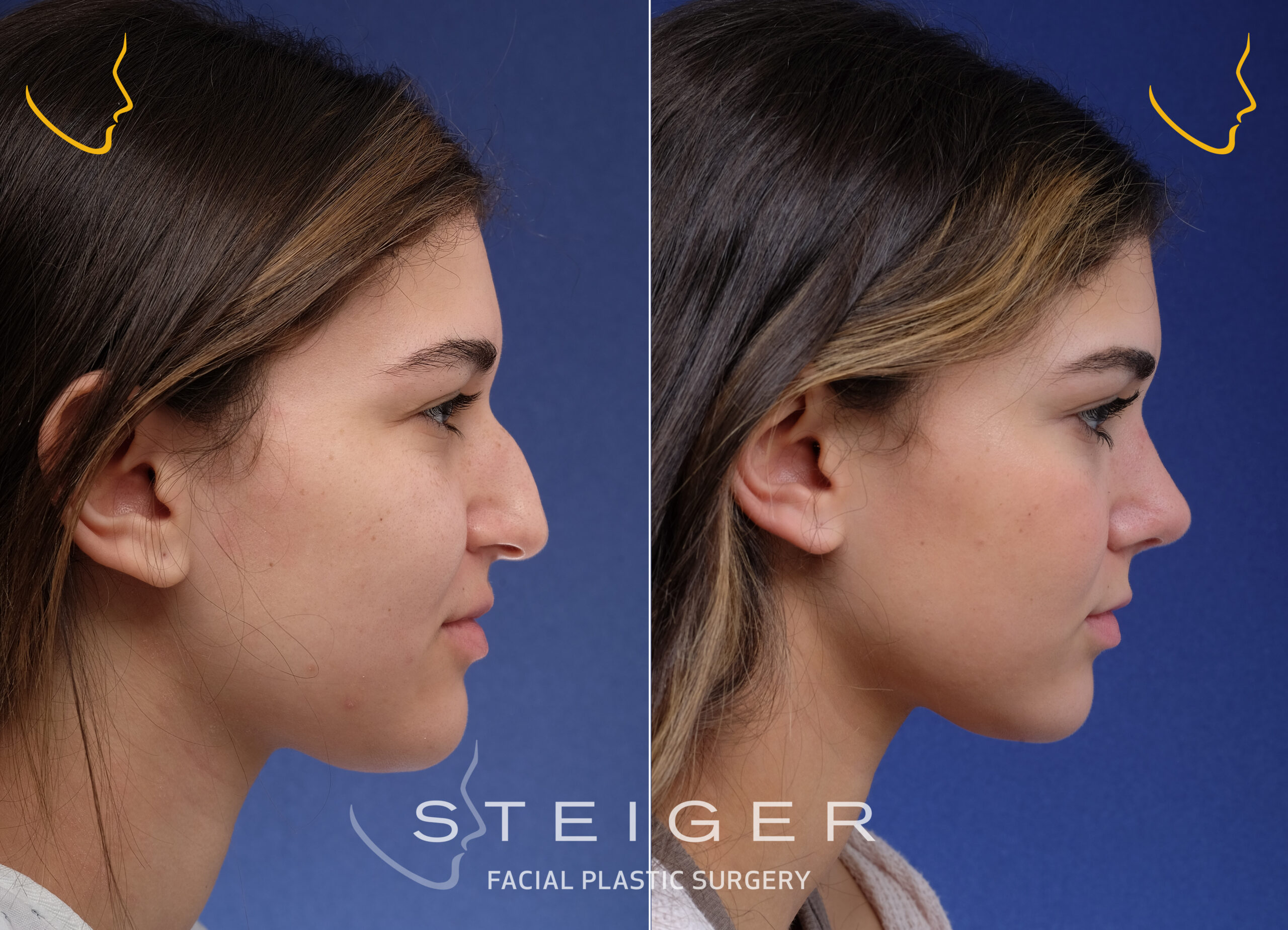 Plastic Surgery Before And After Nose Jobs   Rhinoplasty Before And After Big Hump Scaled 