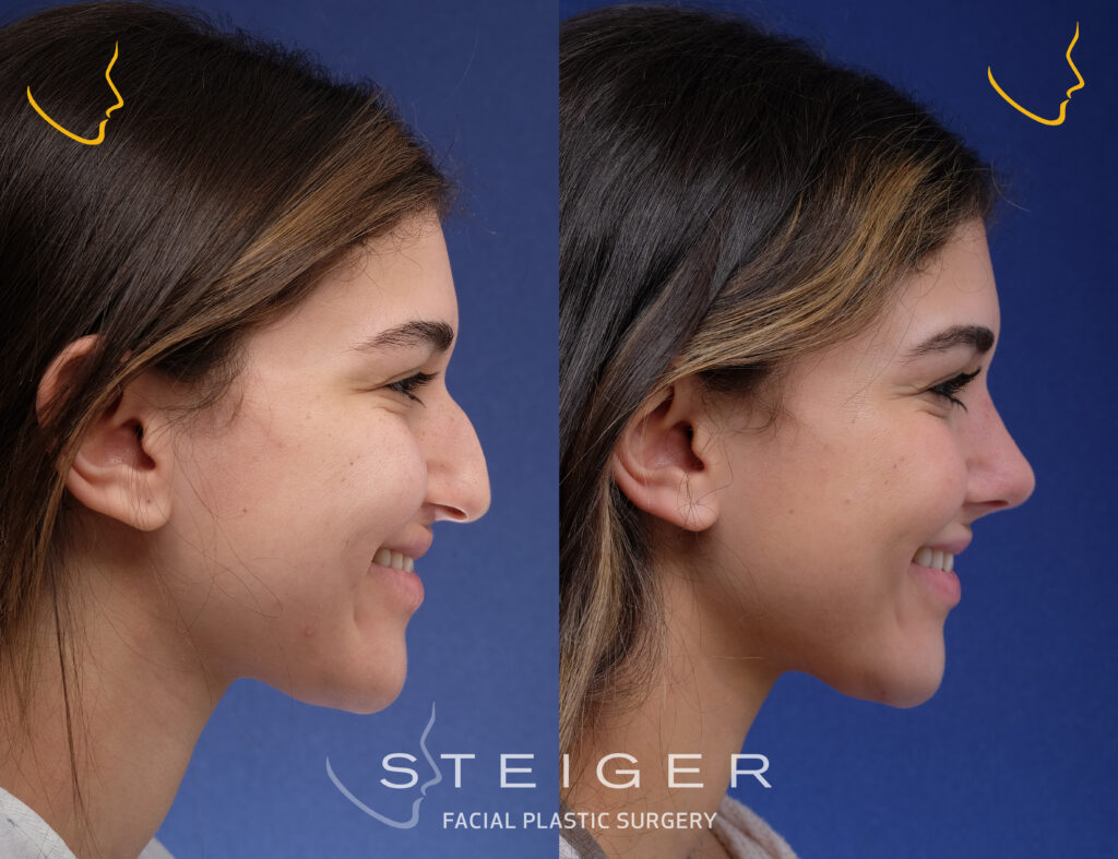 Rhinoplasty Before and After Photos