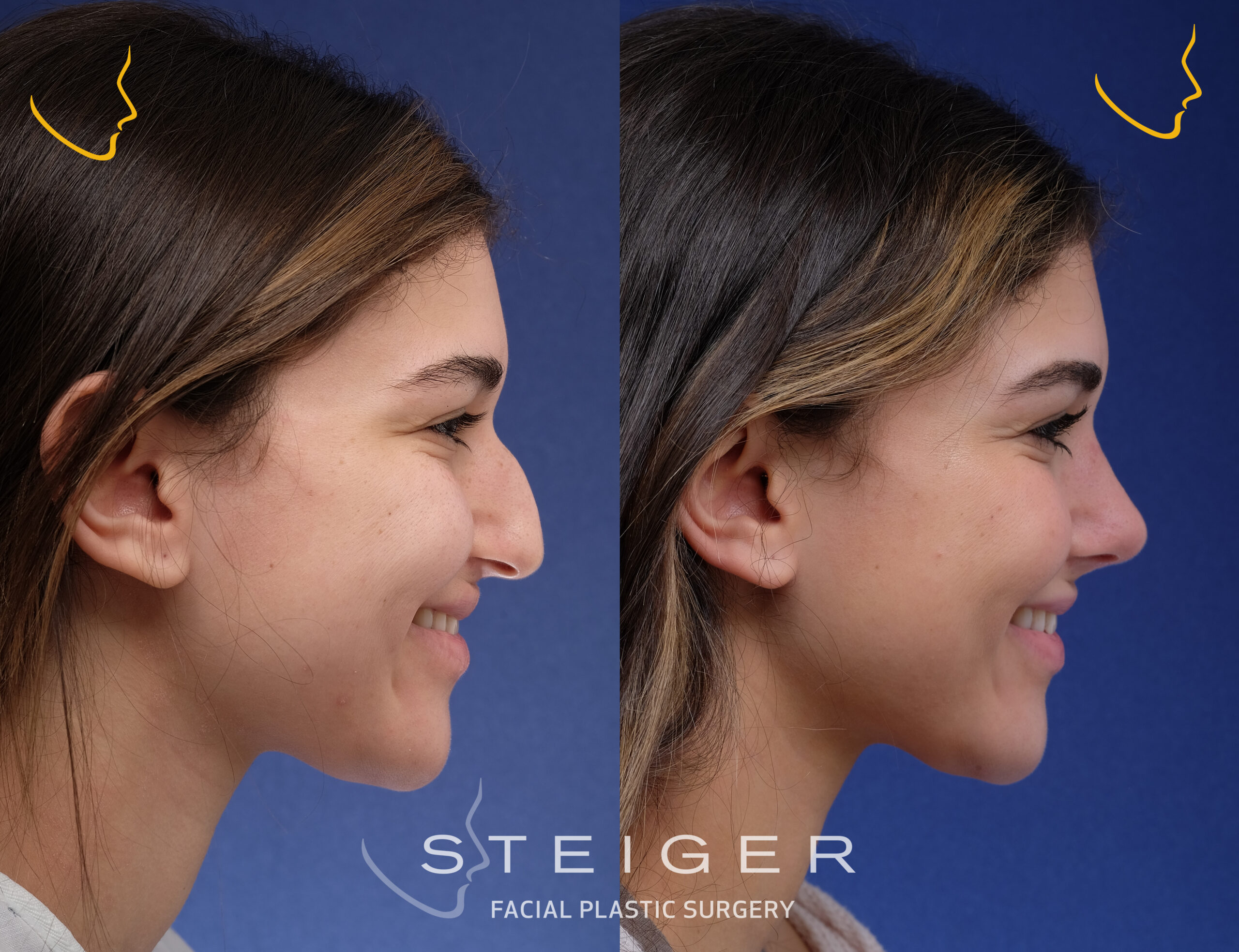 rhinoplastybeforeandafterdroopytip Steiger Facial Plastic