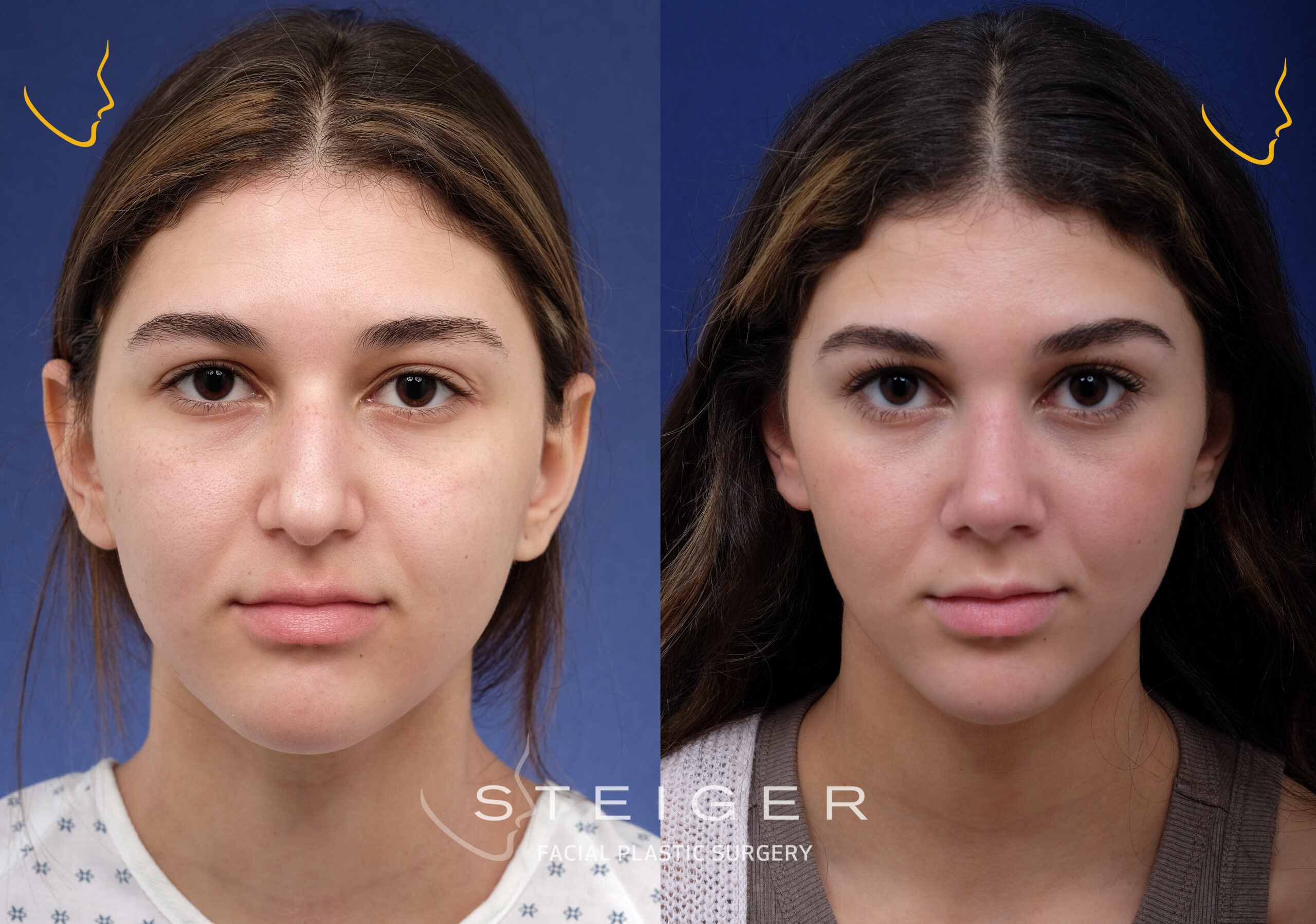 Nose Job Before And After Nose Job Before And After