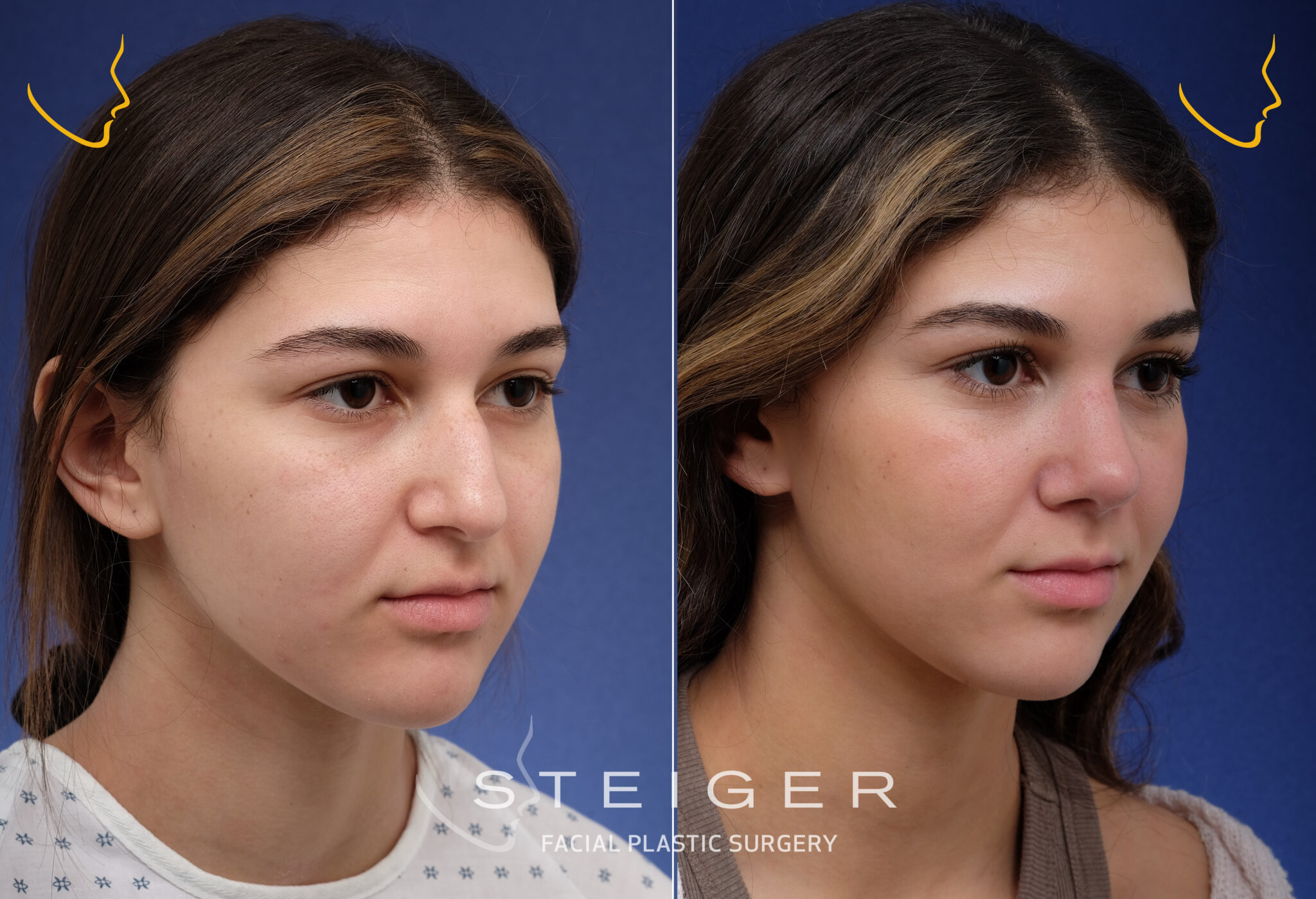 Rhinoplasty Before and After Photos