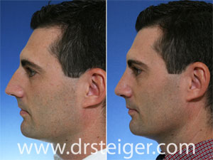 Rhinoplasty Man Before and After Photos