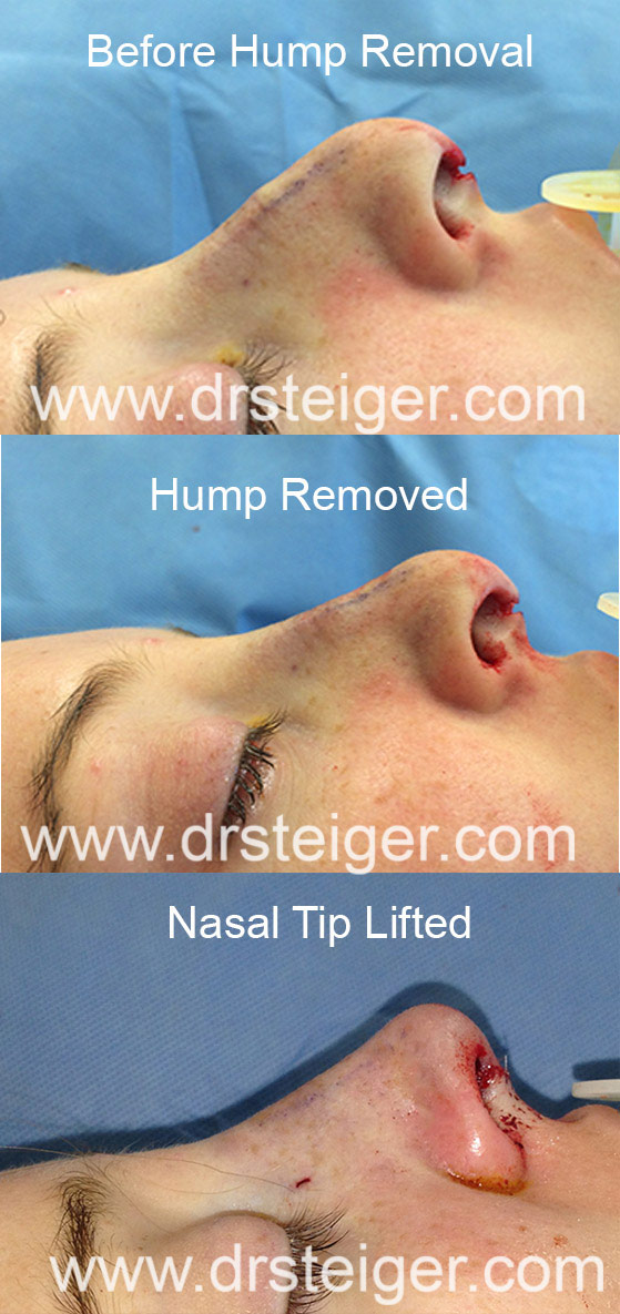 hump removal with tip lift nose job