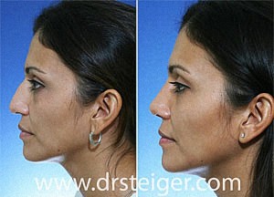rhinoplasty for a droopy tip
