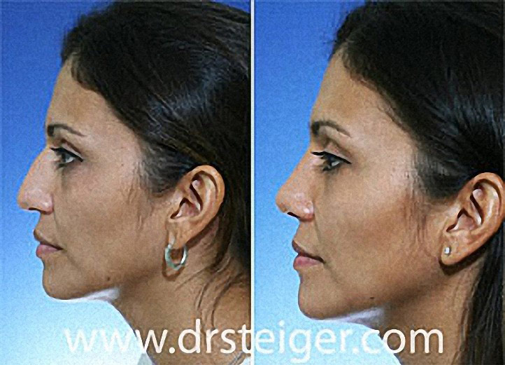 rhinoplasty-ethnic1