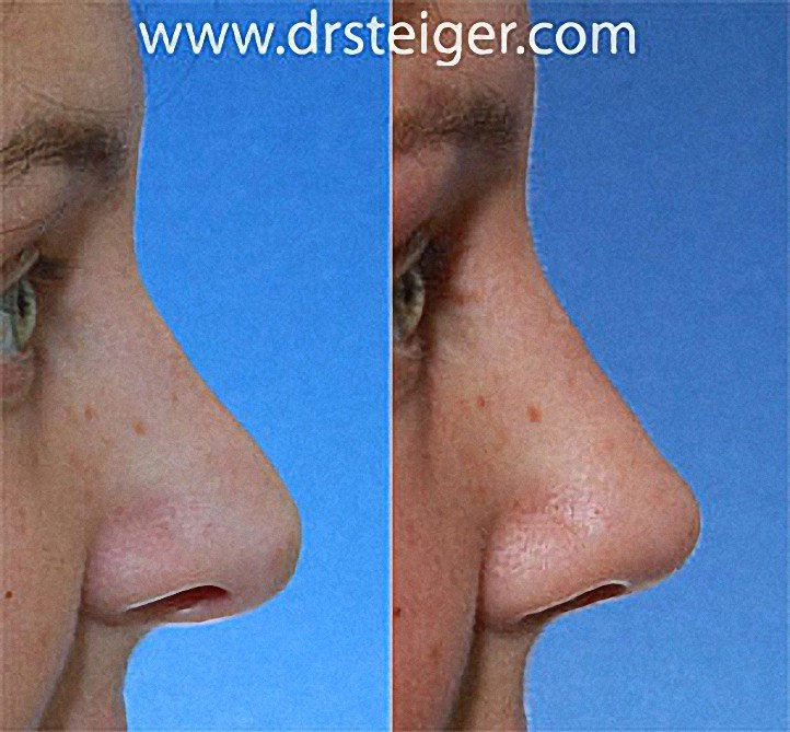 Rhinoplasty for a Hanging Collumela