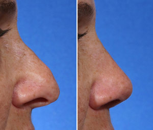 rhinoplasty for a hook nose