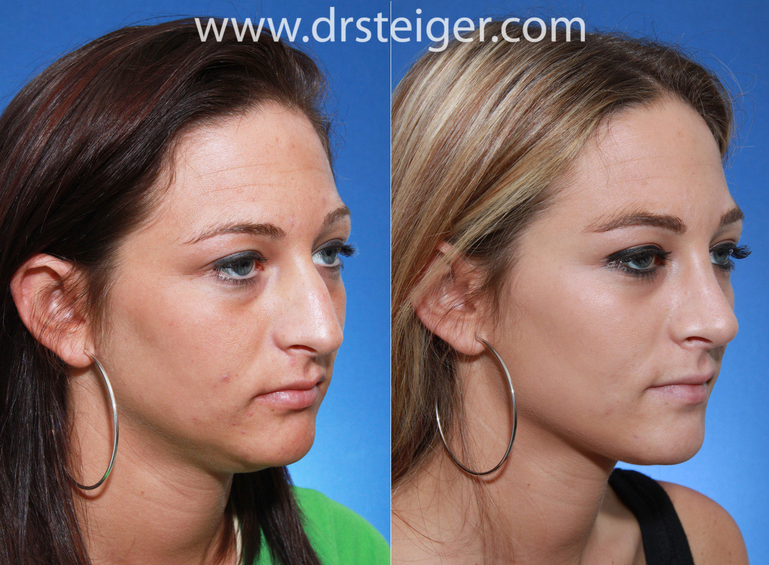 Rhinoplasty Before and After Photos