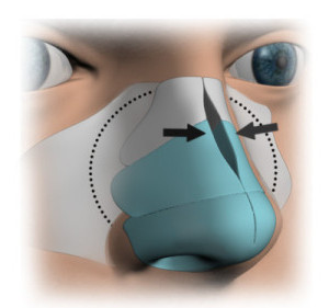 Will you have to break my nose during rhinoplasty?