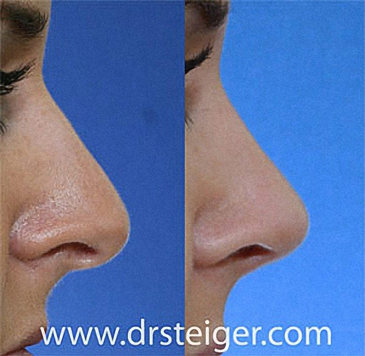 rhinoplasty-tip1