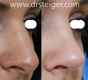 rhinoplasty to lift the tip of the nose