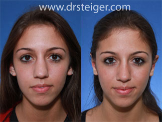 rhinoplasty-to-narrow-nose-small